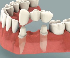 Dental Bridges