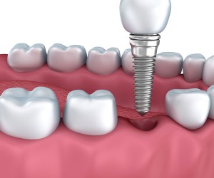 Dental Implants