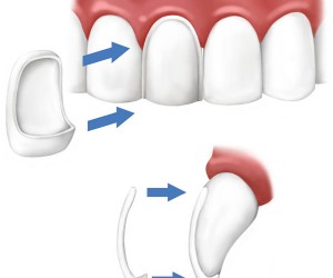 Porcelain Veneers